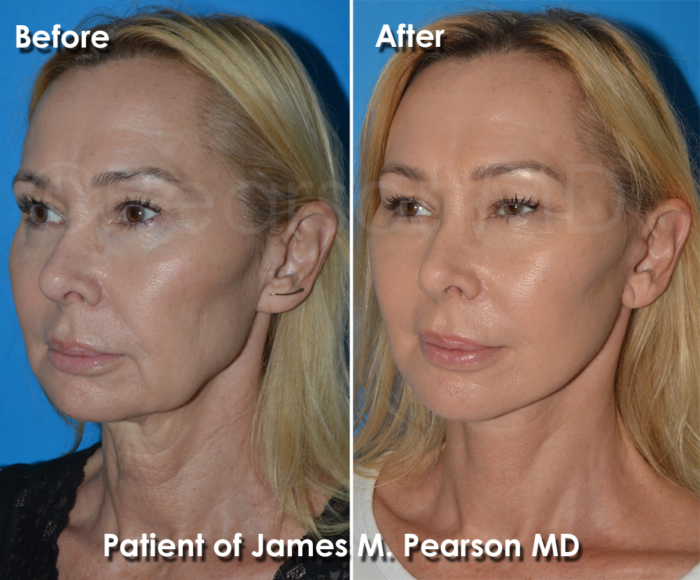 Facelift Dr. Pearson
