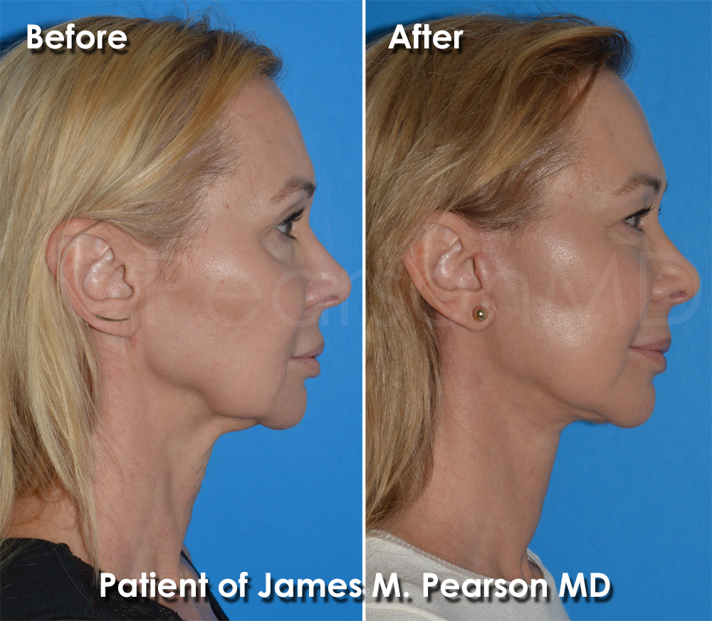 Pearson Plastic Surgery