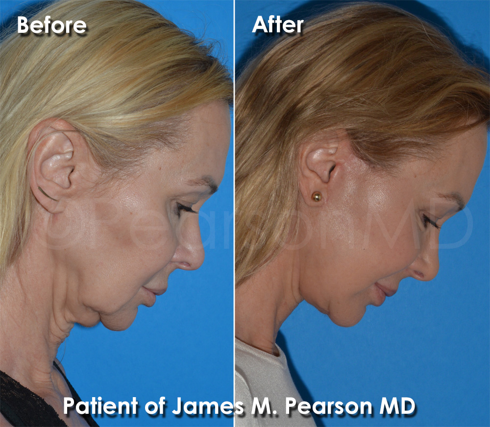 Dr. Pearson Cosmetic Surgery