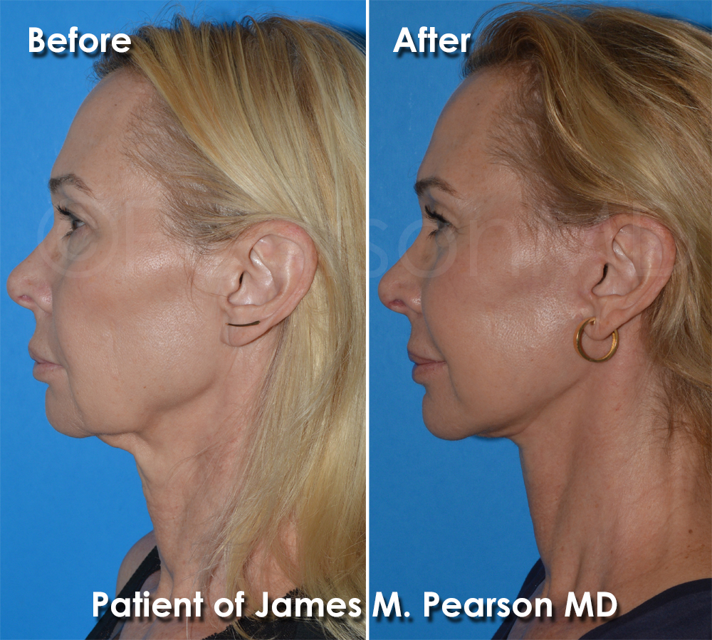 Pearson Plastic Surgery