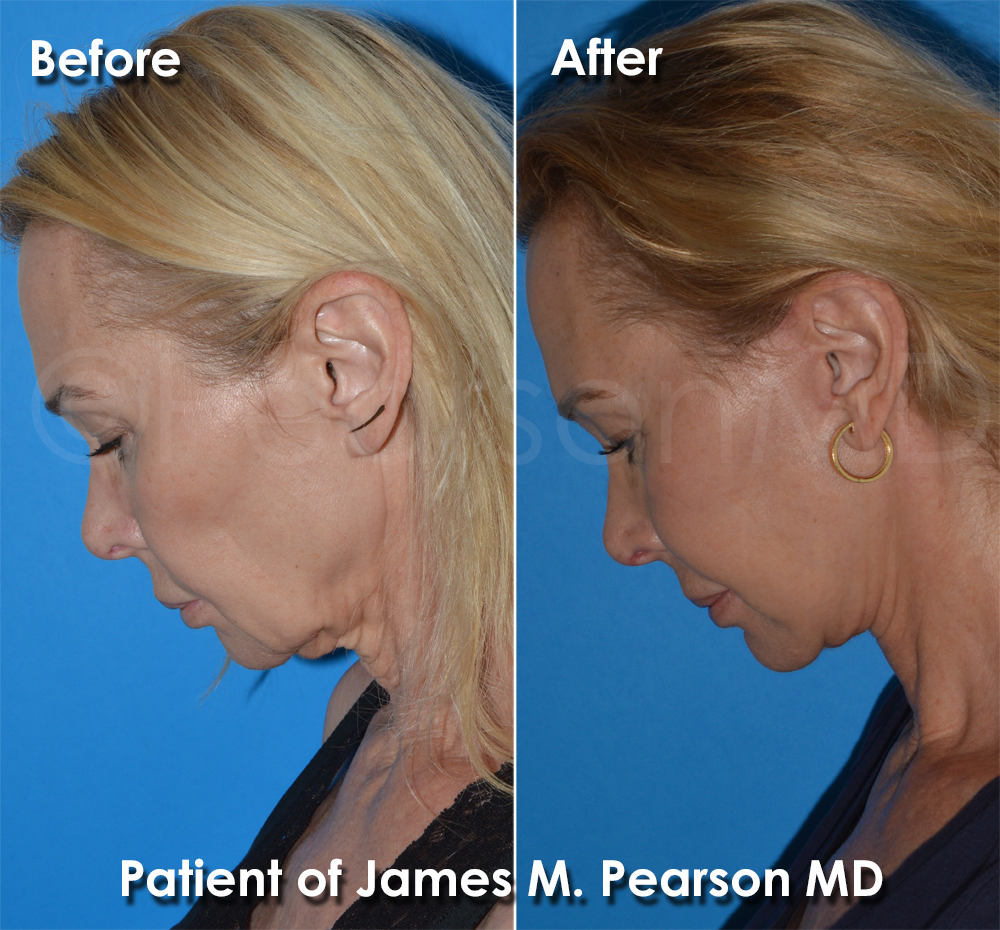 Pearson Plastic Surgery
