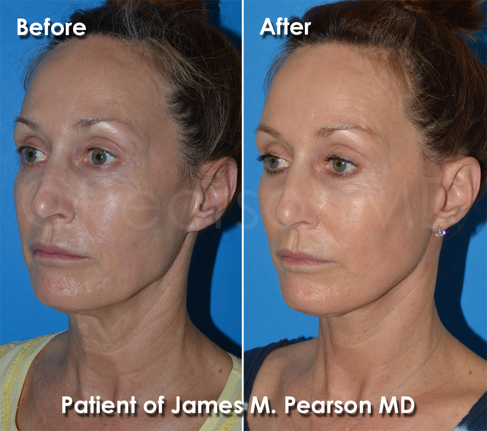 Facelift Dr. Pearson