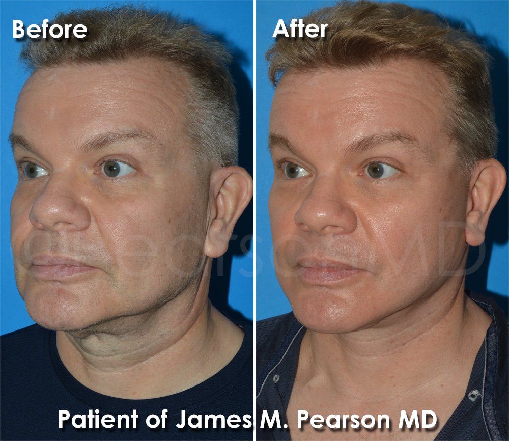 Facelift for Men Torrance