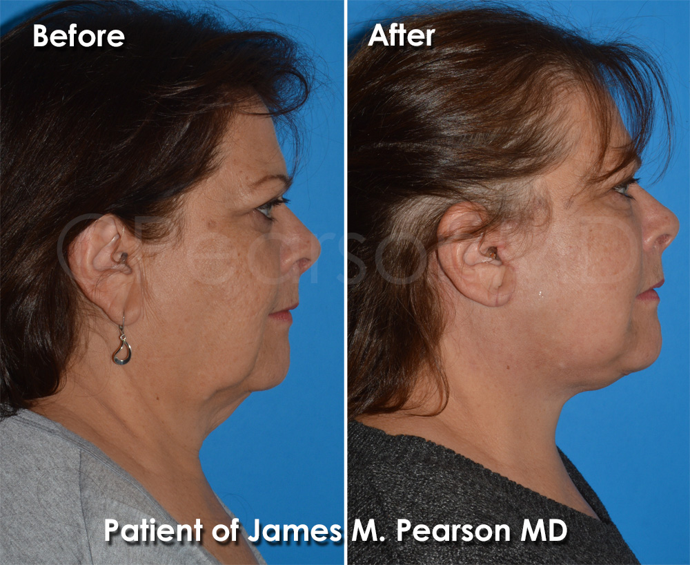 Facelift Manhattan Beach