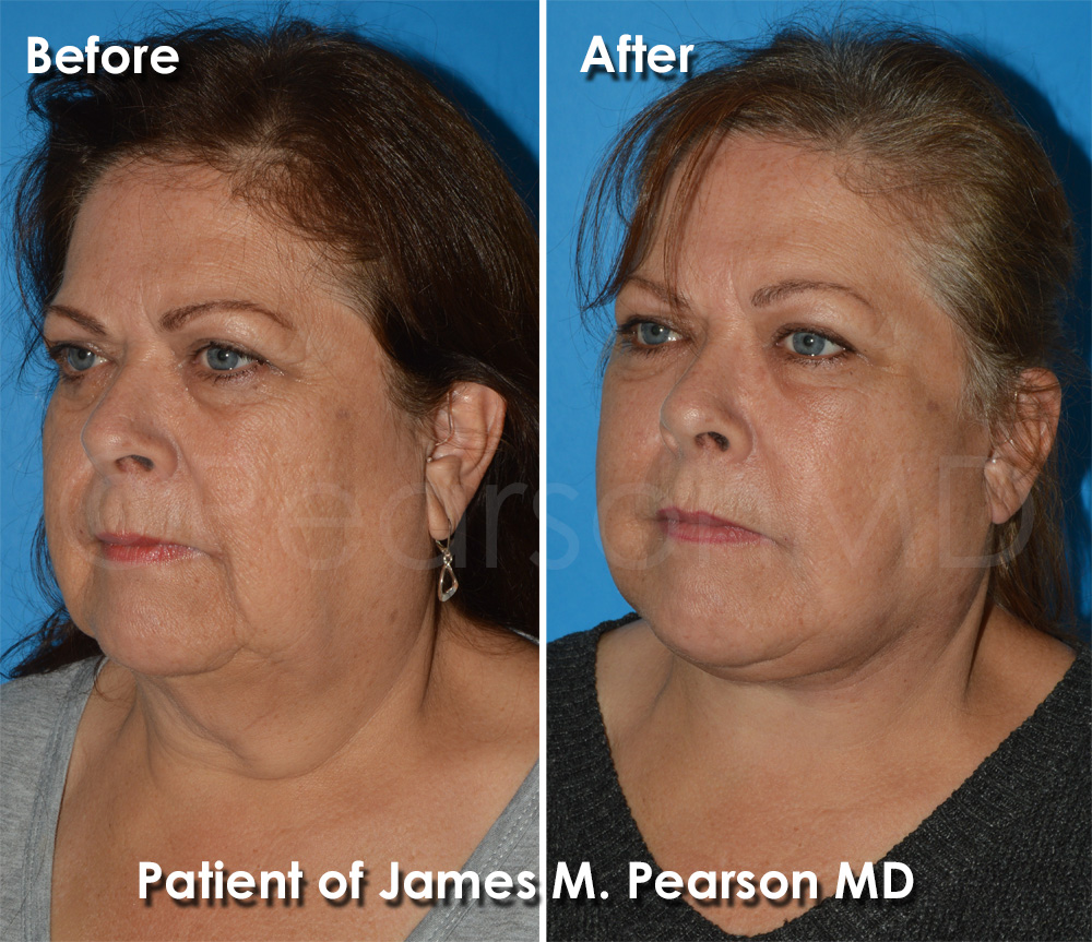 Facelift Huntington Beach