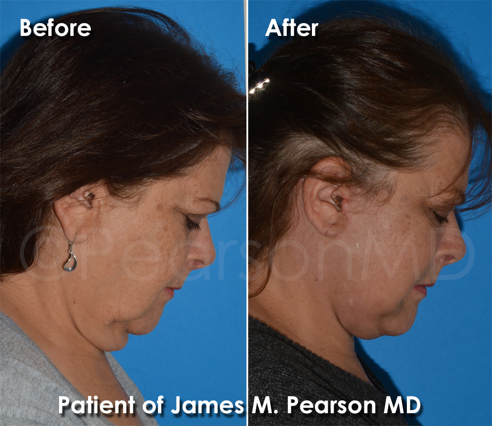 Pearson Plastic Surgery
