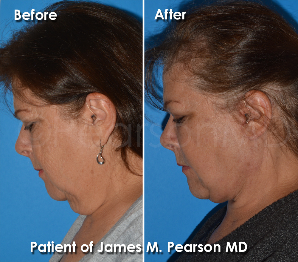 Pearson Cosmetic Surgery