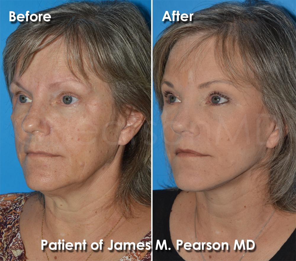 Dr. Pearson Plastic Surgery