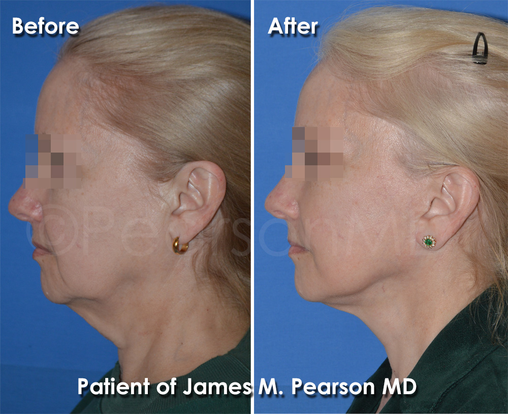 Dr. Pearson Facelift
