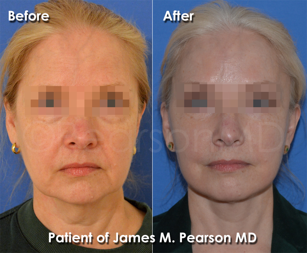 Pearson Plastic Surgery