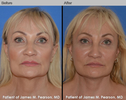Pearson Revision Facelift Photos