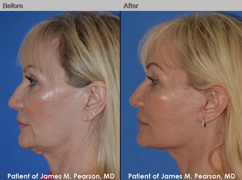 Pearson Revision Facelift Photos