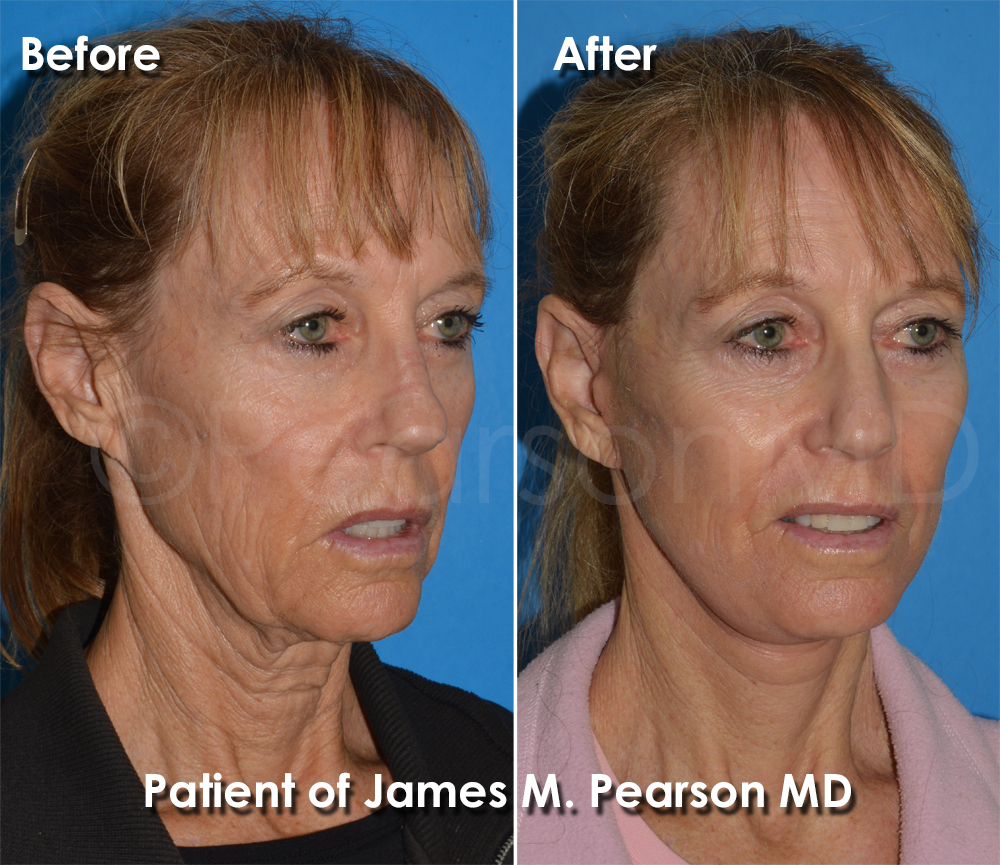 Pearson Plastic Surgery