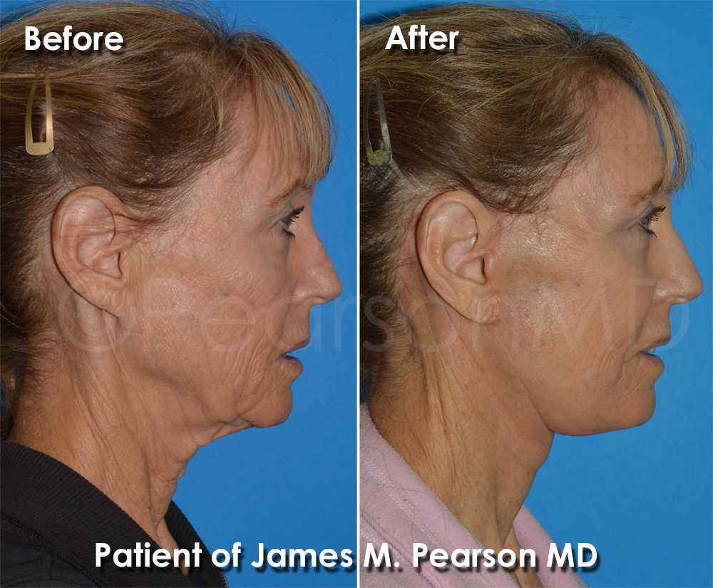 Pearson Facelift