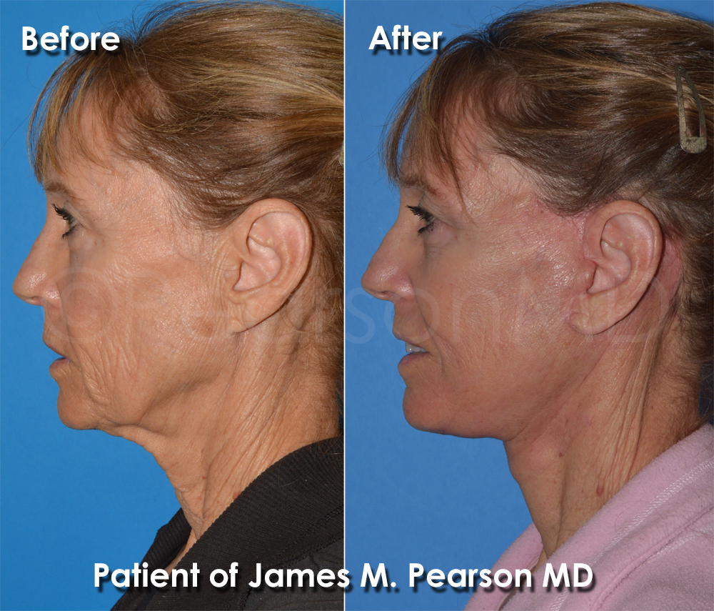 Dr. Pearson Facelift