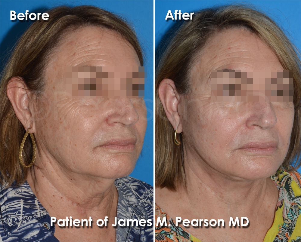 Dr. Pearson Plastic Surgery