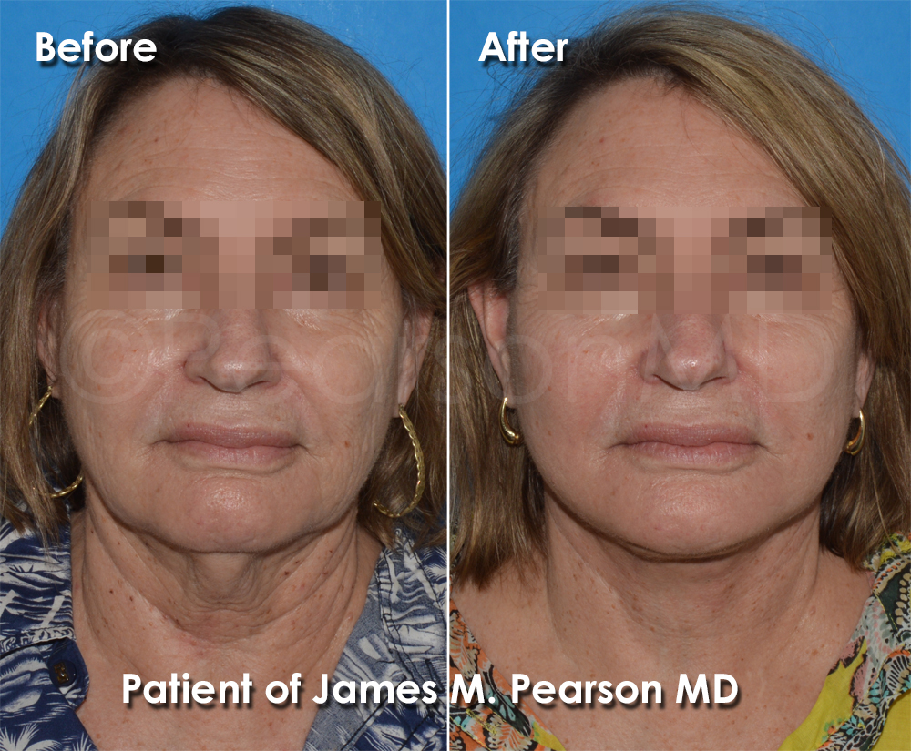 Dr. Pearson Plastic Surgeon