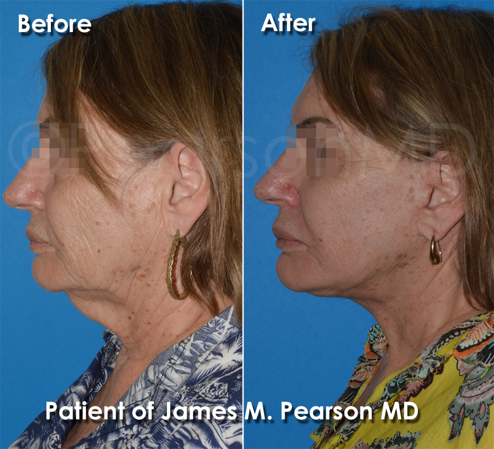 Pearson Plastic Surgery