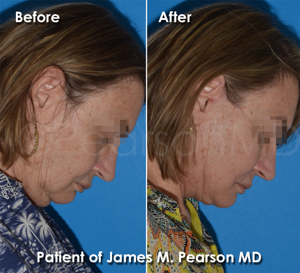 Dr. Pearson Facelift