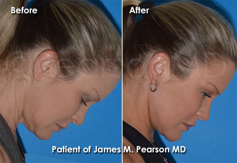Pearson Plastic Surgery