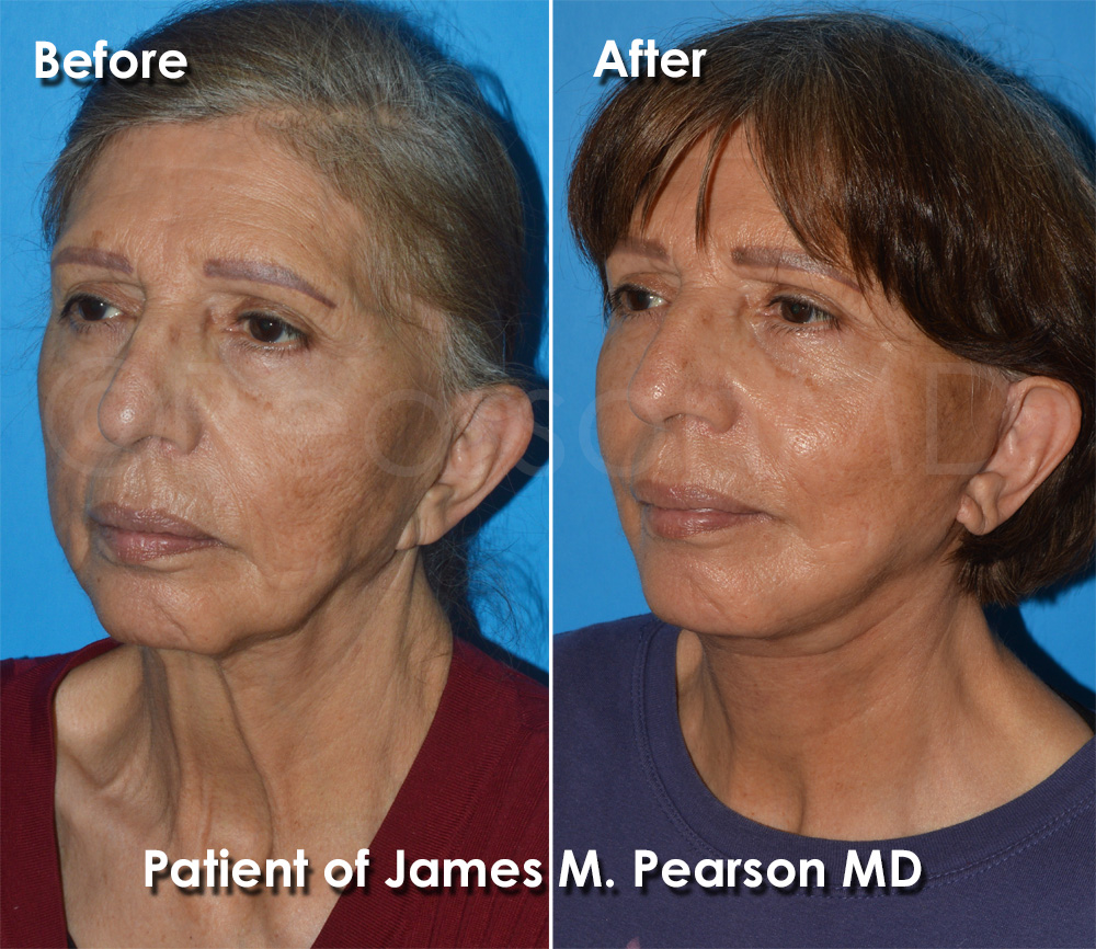 Dr. Pearson Facelift