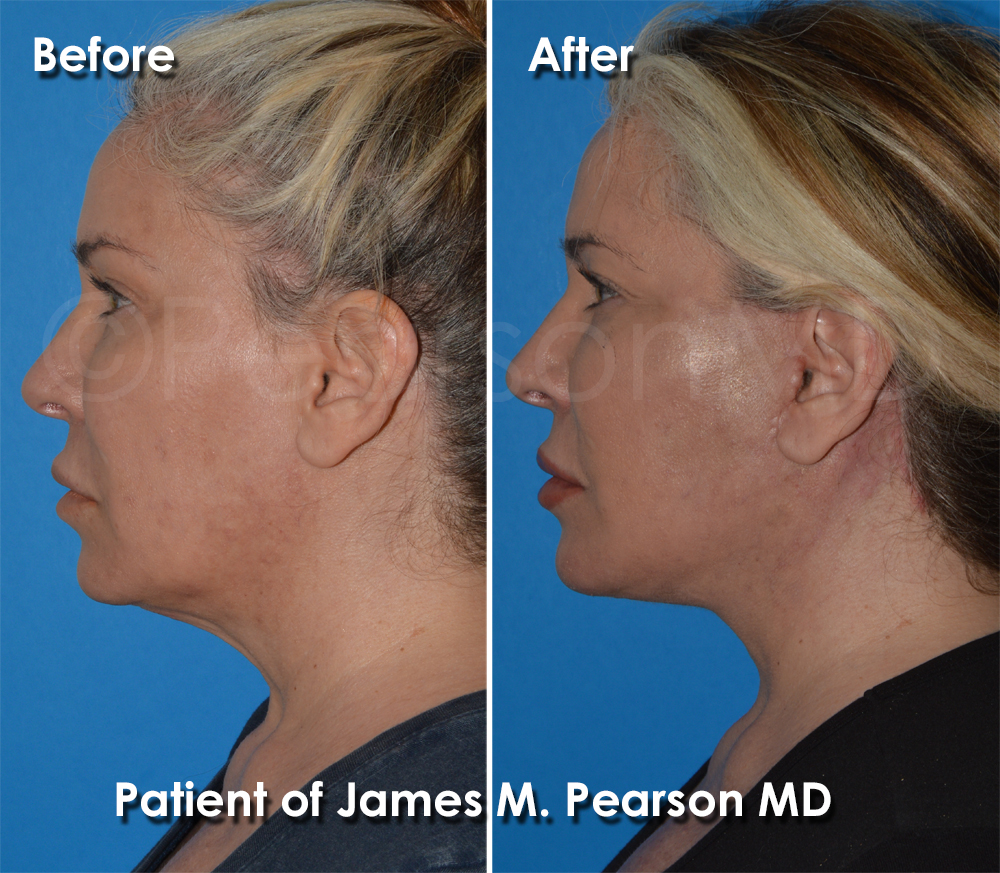 Dr. Pearson Facelift