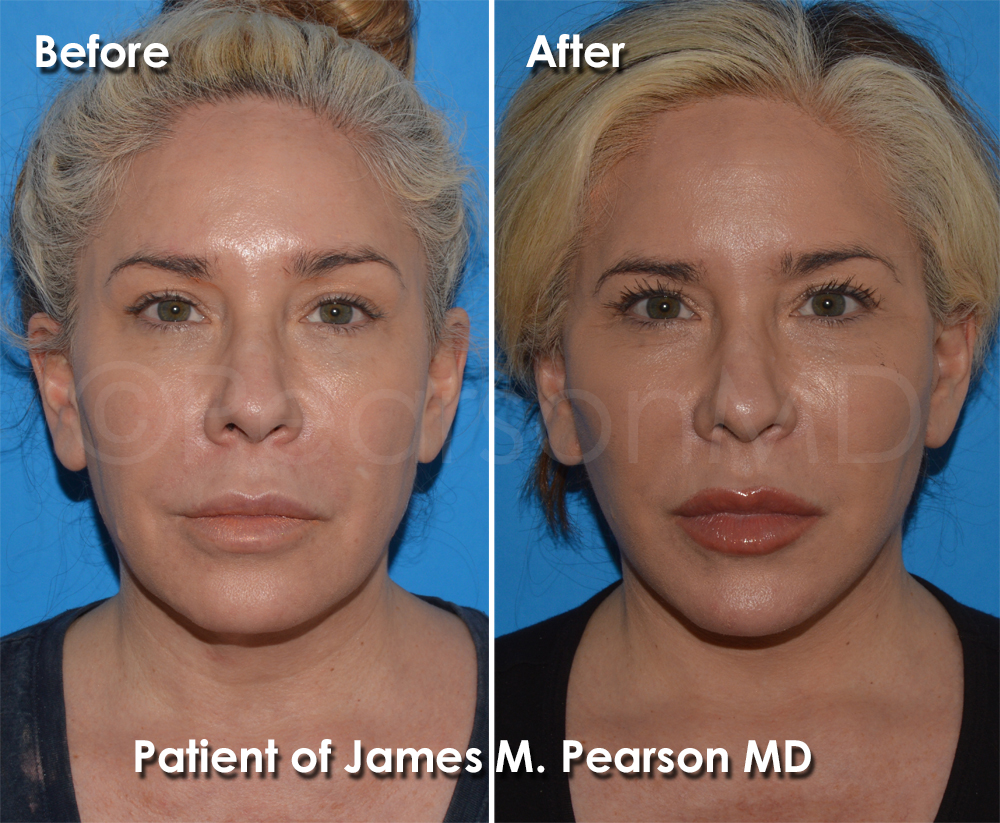 Pearson Plastic Surgery