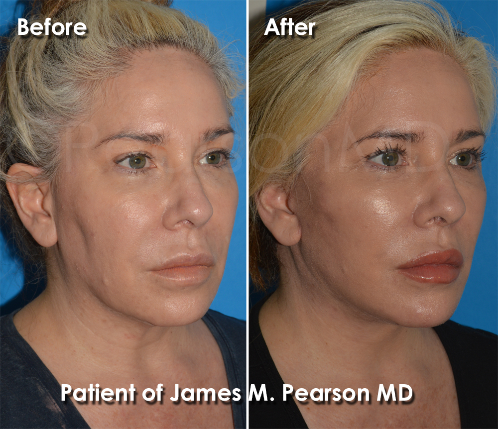 Redondo Beach Facelift Plastic Surgeon