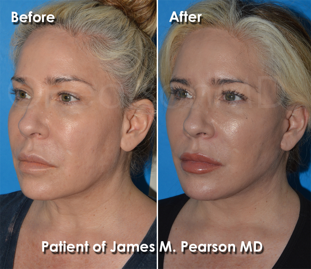 Hermosa Beach Facelift Plastic Surgeon
