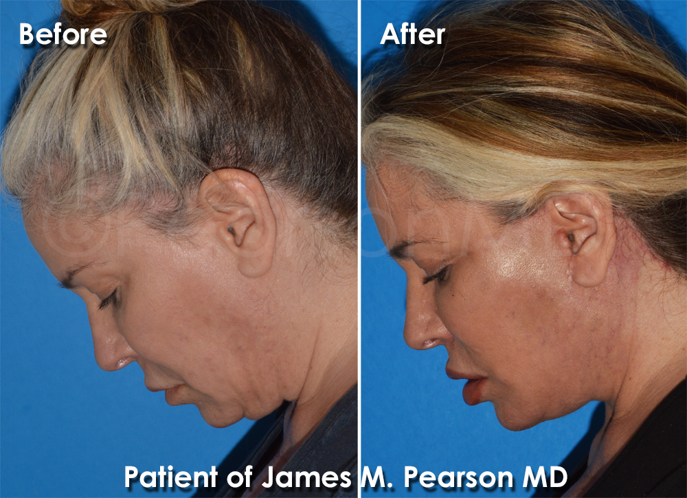 Manhattan Beach Facelift Plastic Surgeon