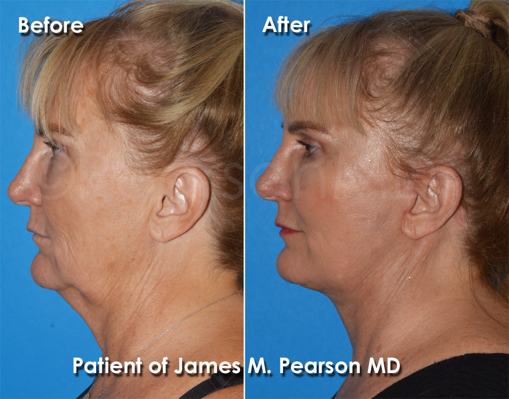 Dr. Pearson Facelift