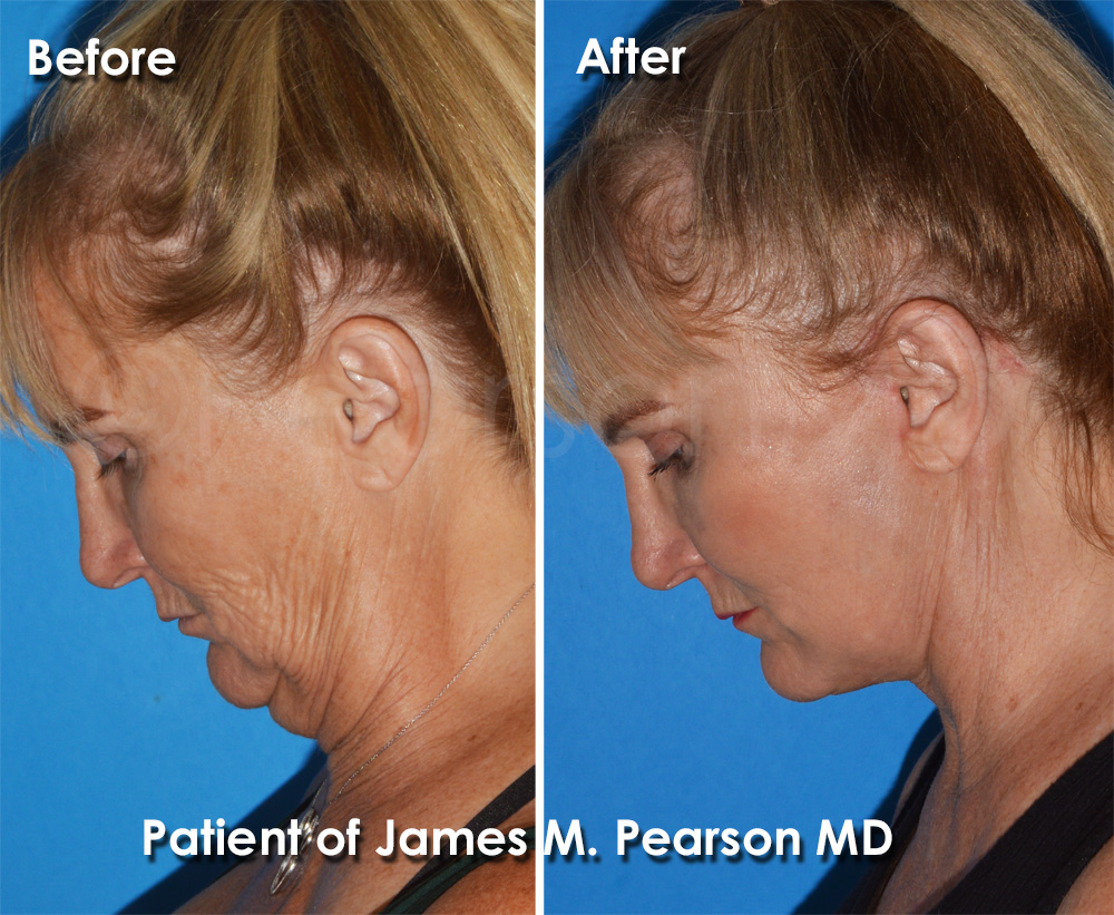 Redondo Beach Facelift Plastic Surgeon
