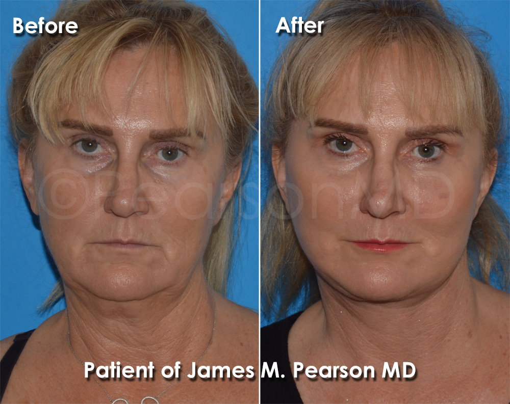 Hermosa Beach Facelift Plastic Surgeon