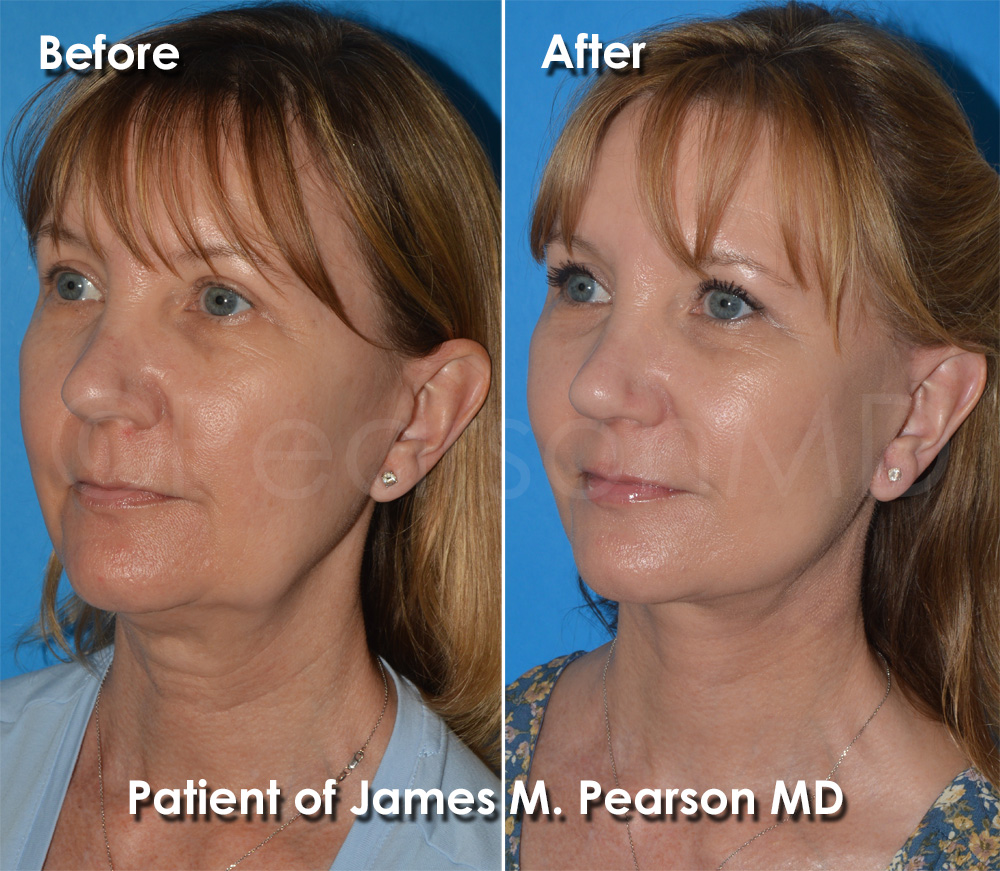 Dr. Pearson Facelift