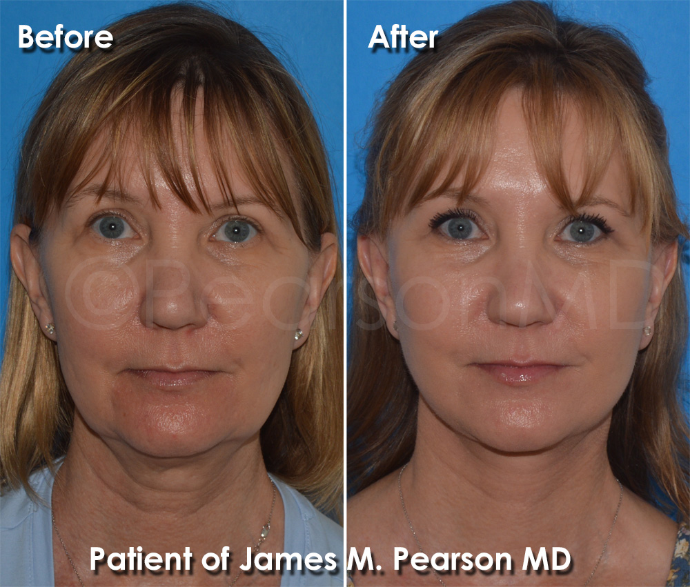 Dr. Pearson Facelift