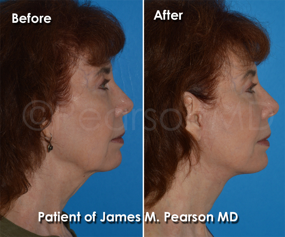 Dr. Pearson Facelift Surgery