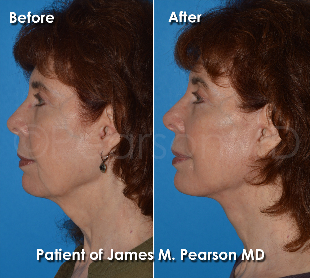 Dr. Pearson Facelift Surgery