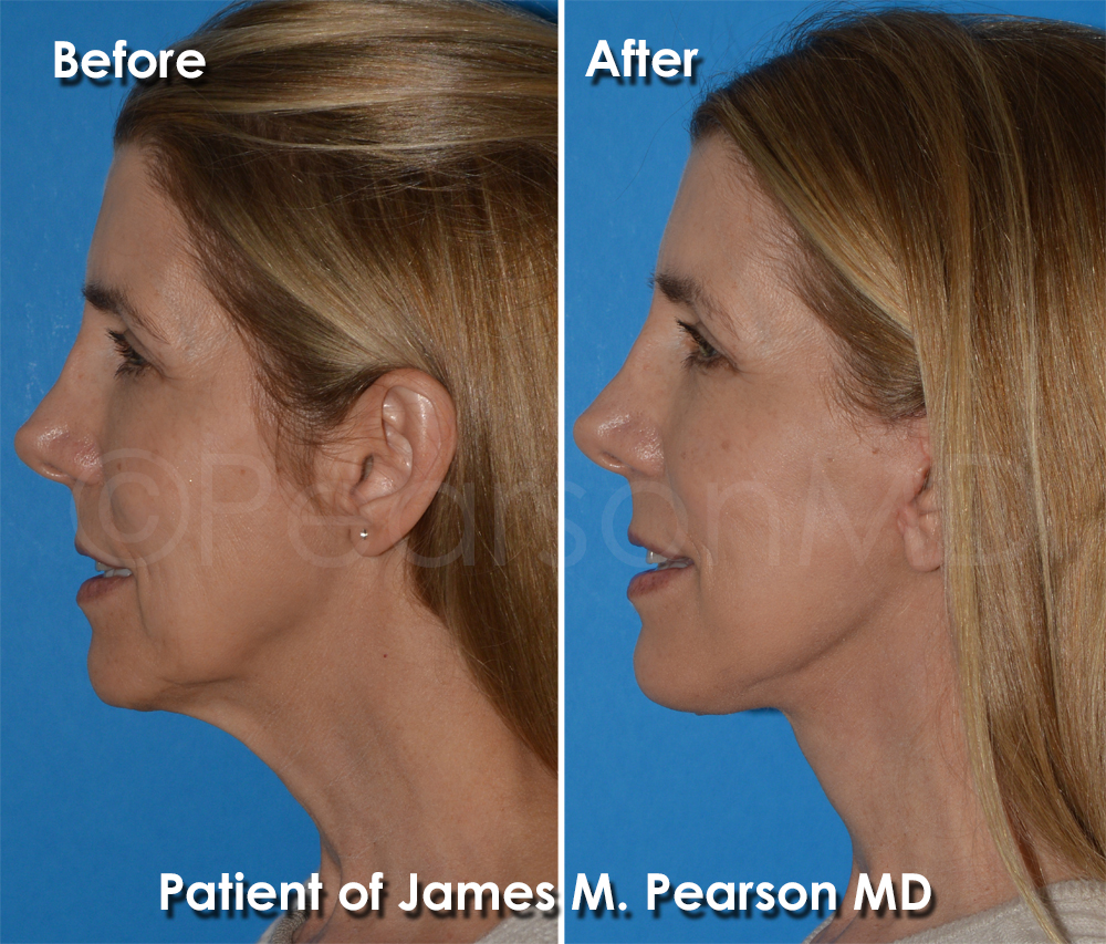 Dr. Pearson Facelift