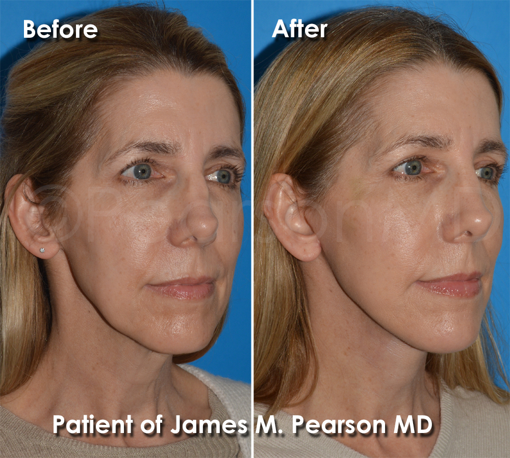 Pearson Plastic Surgery
