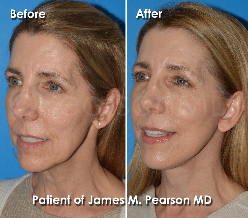 Dr. Pearson Facelift Surgery