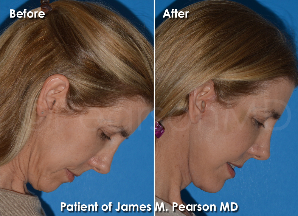 Dr. Pearson Facelift Surgery