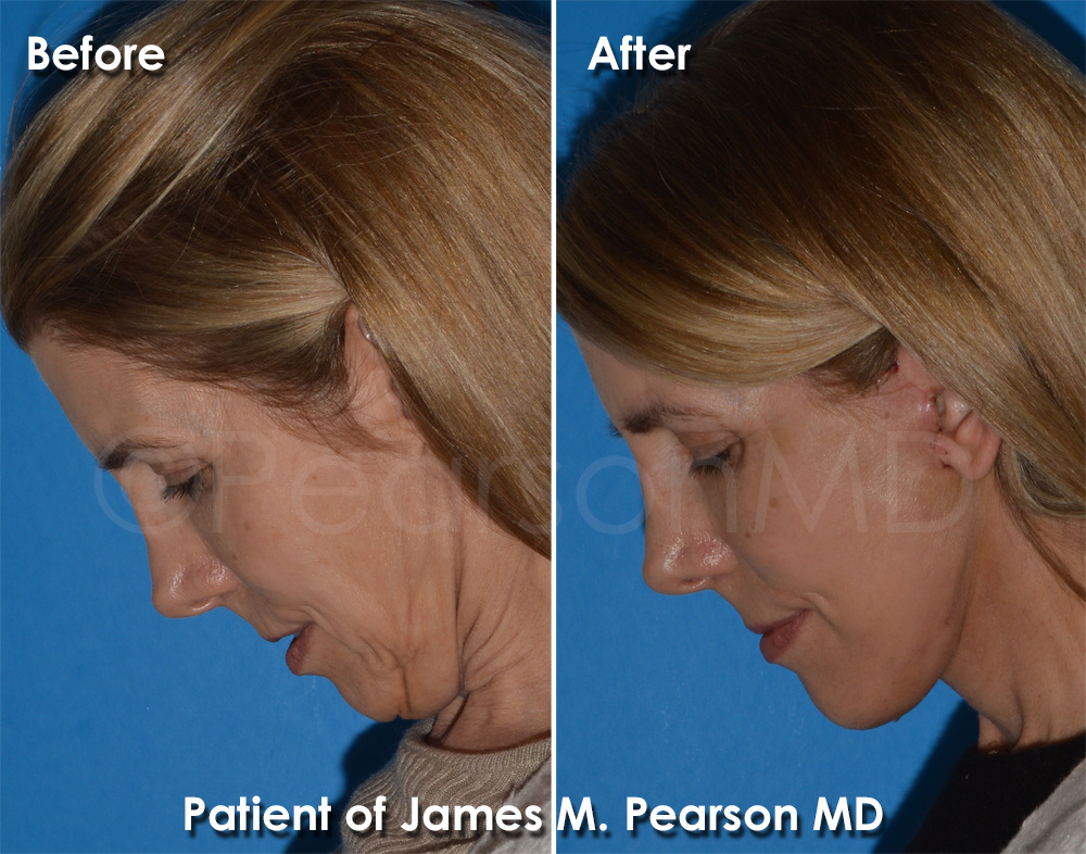 Pearson Plastic Surgery