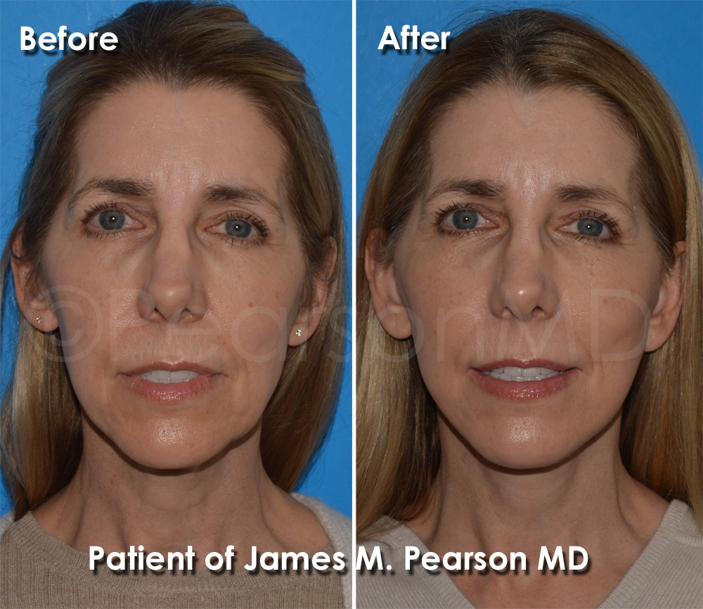 Pearson Plastic Surgery