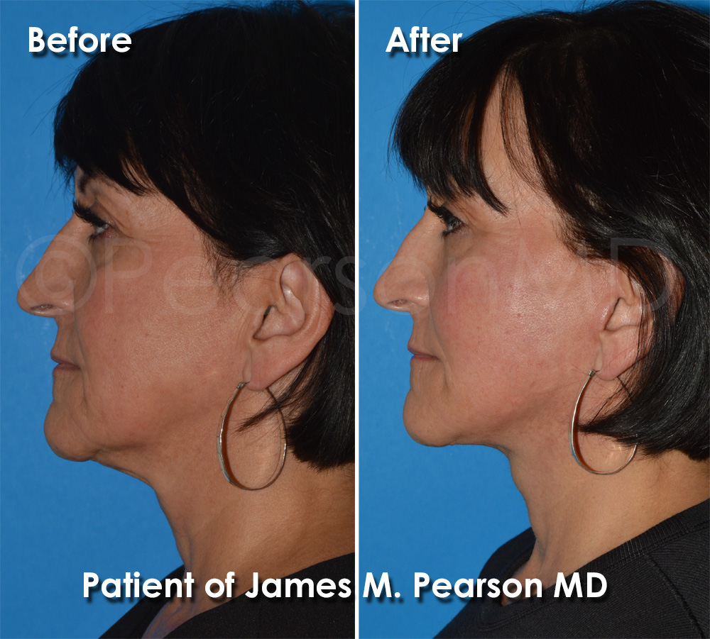 Dr. Pearson Facelift
