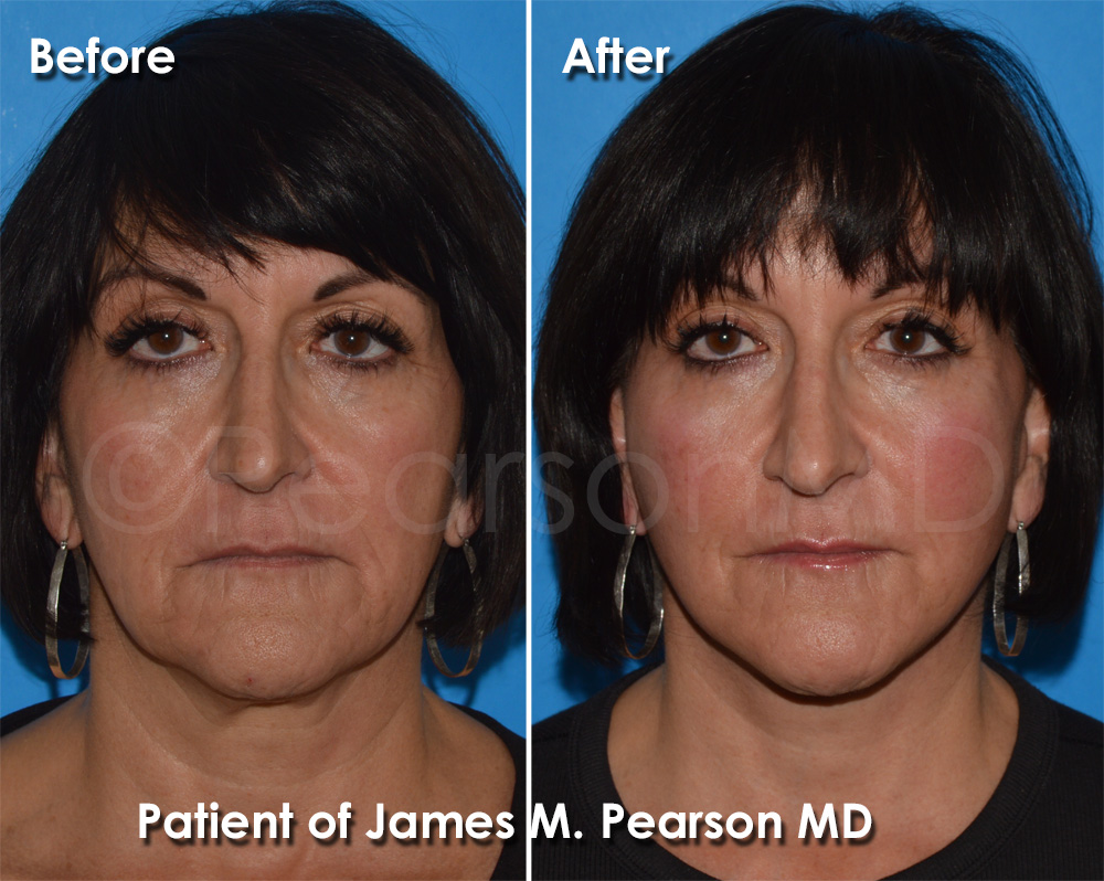 Pearson Plastic Surgery