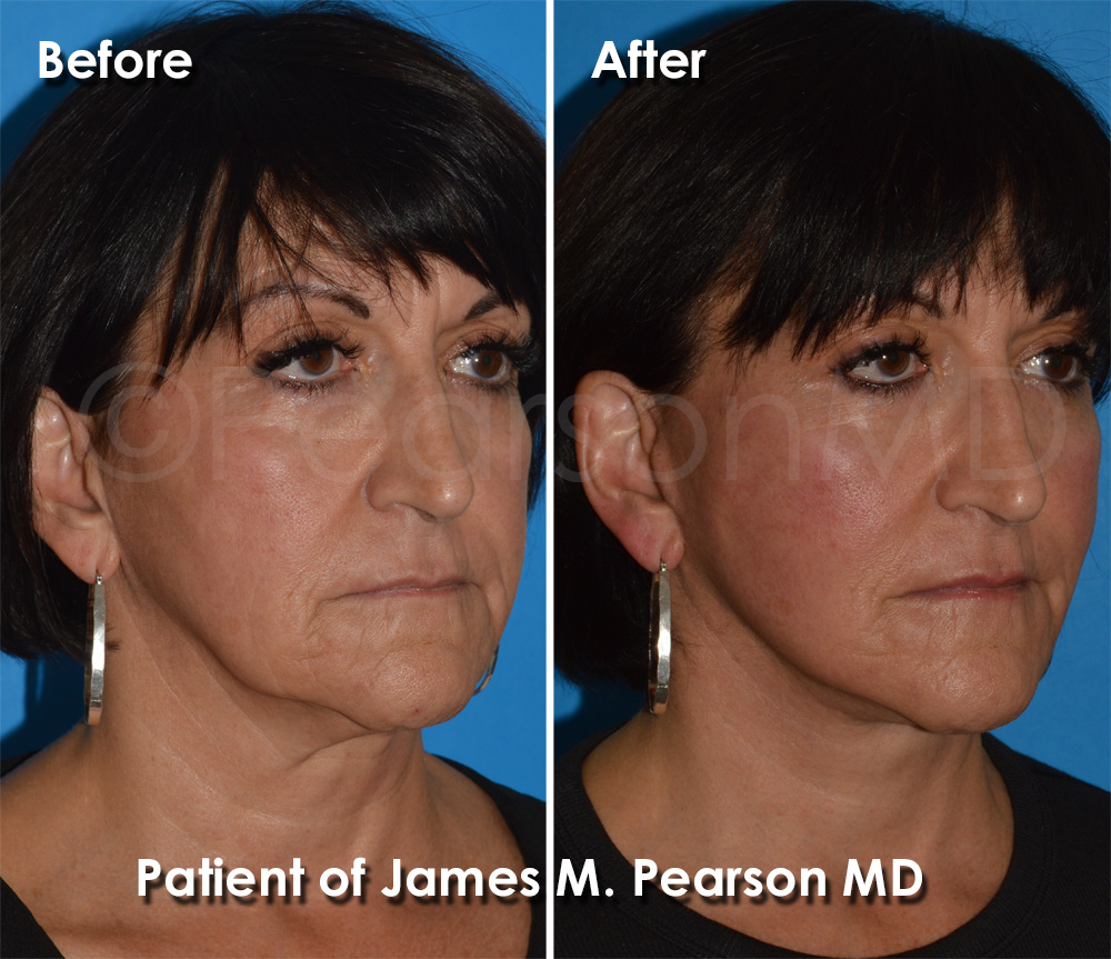 Dr. Pearson Facelift Surgery