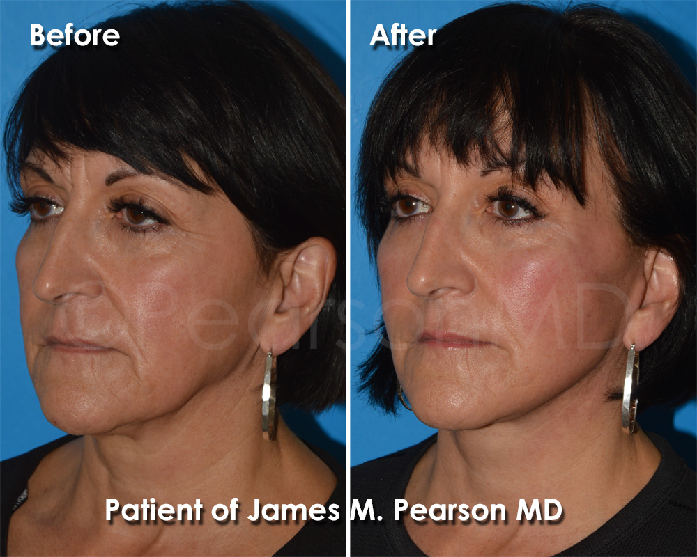Dr. Pearson Facelift Surgery