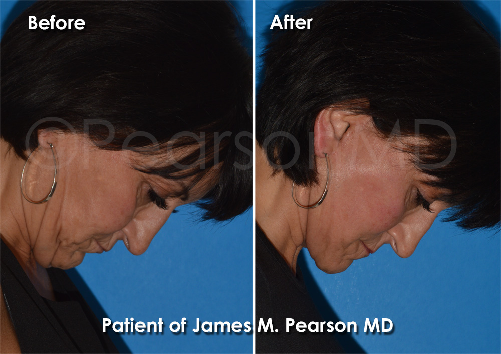 Dr. Pearson Facelift Surgery