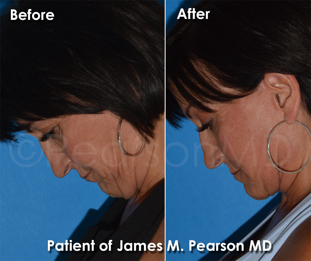 Dr. Pearson Facelift Surgery