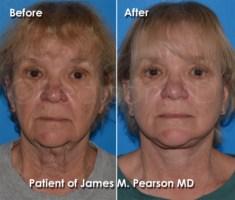 Pearson Plastic Surgery